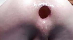 Anal rosebud prolapse